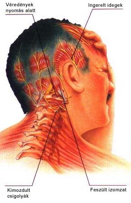 headache-01_419_01 headache-01_419_01